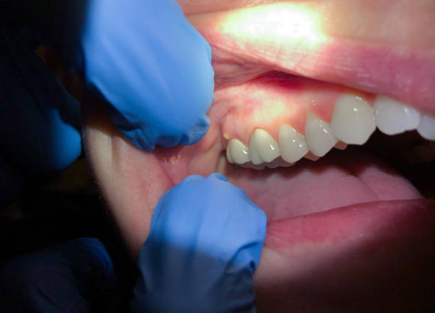 Best Emergency Dentist for Knocked-Out Tooth in Lockport, NY